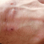 Sindromul Morgellons